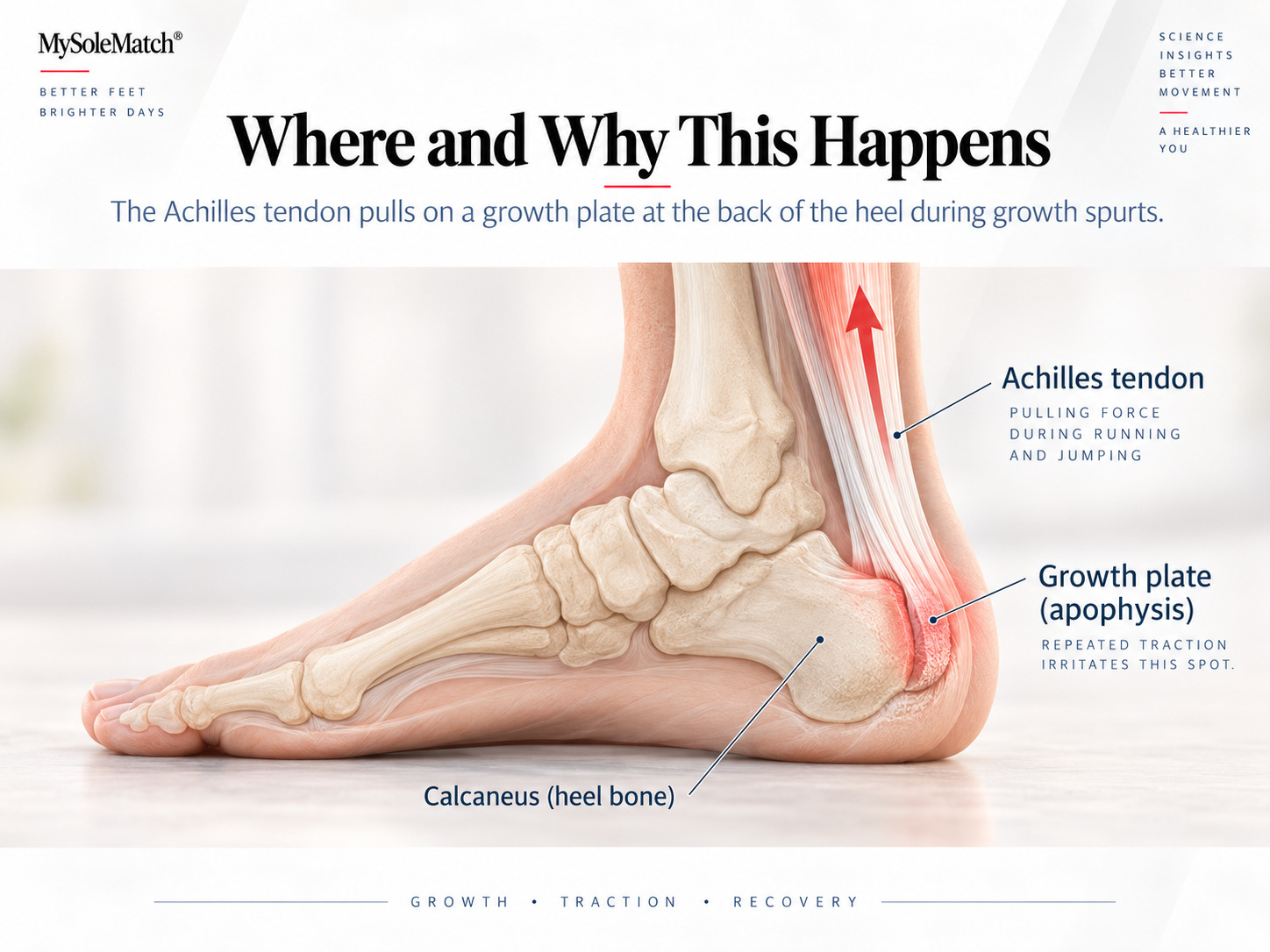 Anatomical diagram of the heel showing the calcaneal growth plate and Achilles tendon insertion point, with traction force indicated